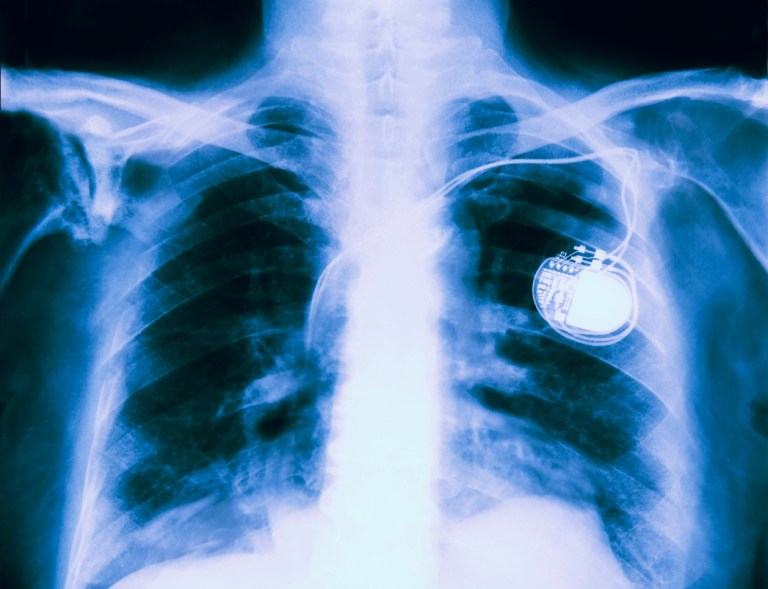 Bugs in medical implants can be exploited over their wireless interfaces, too. For example: lethal shocks from implanted pacemakers and defibrillators.