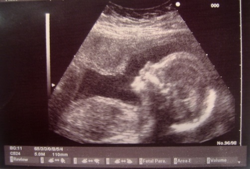 Ultrasonic baby