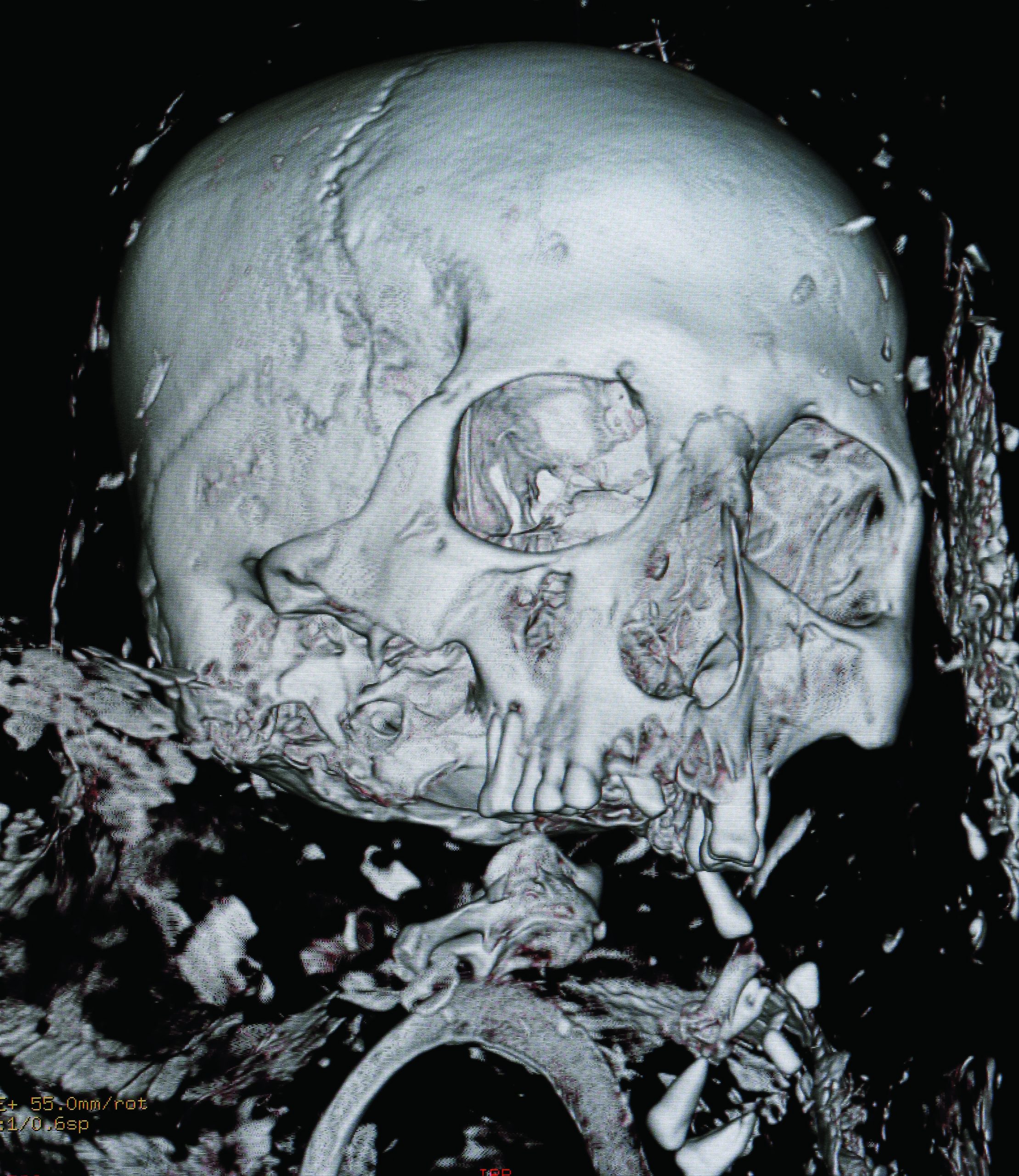 Richmond museum unwrapping mummy’s story with CT scan