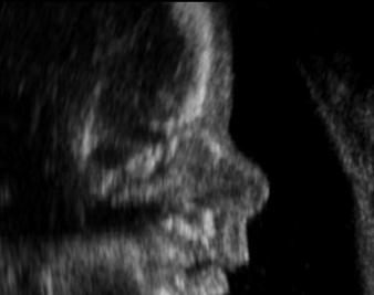 Revisit the Born-Alive Act