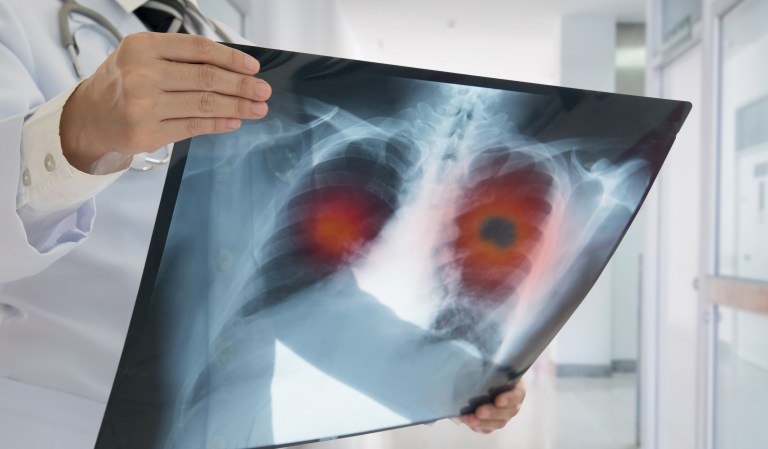 Coronavirus may infect lungs via the gums and not airways, new study finds