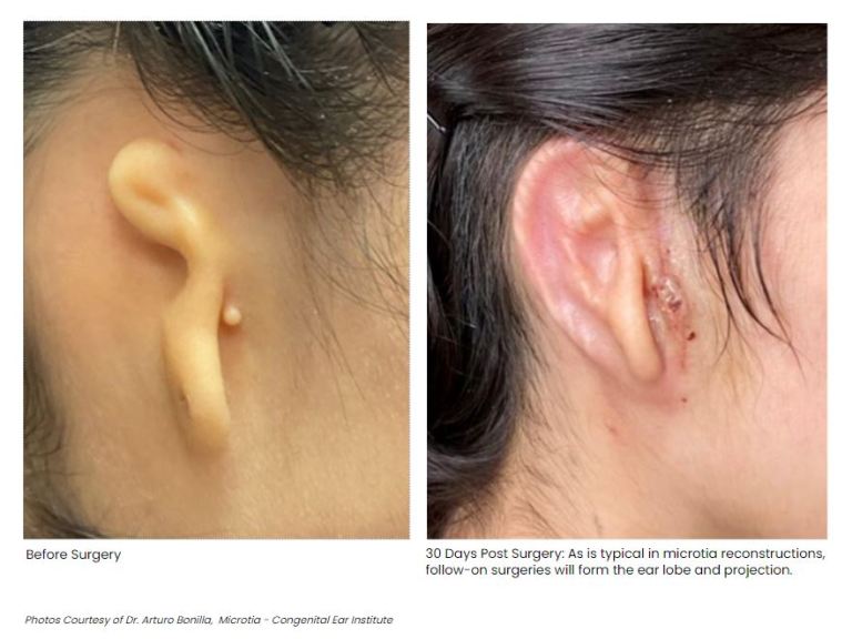 Doctors have successfully transplanted a 3D-printed ear made from human cells onto the face of a 20-year-old woman who was born with a misshapen ear.