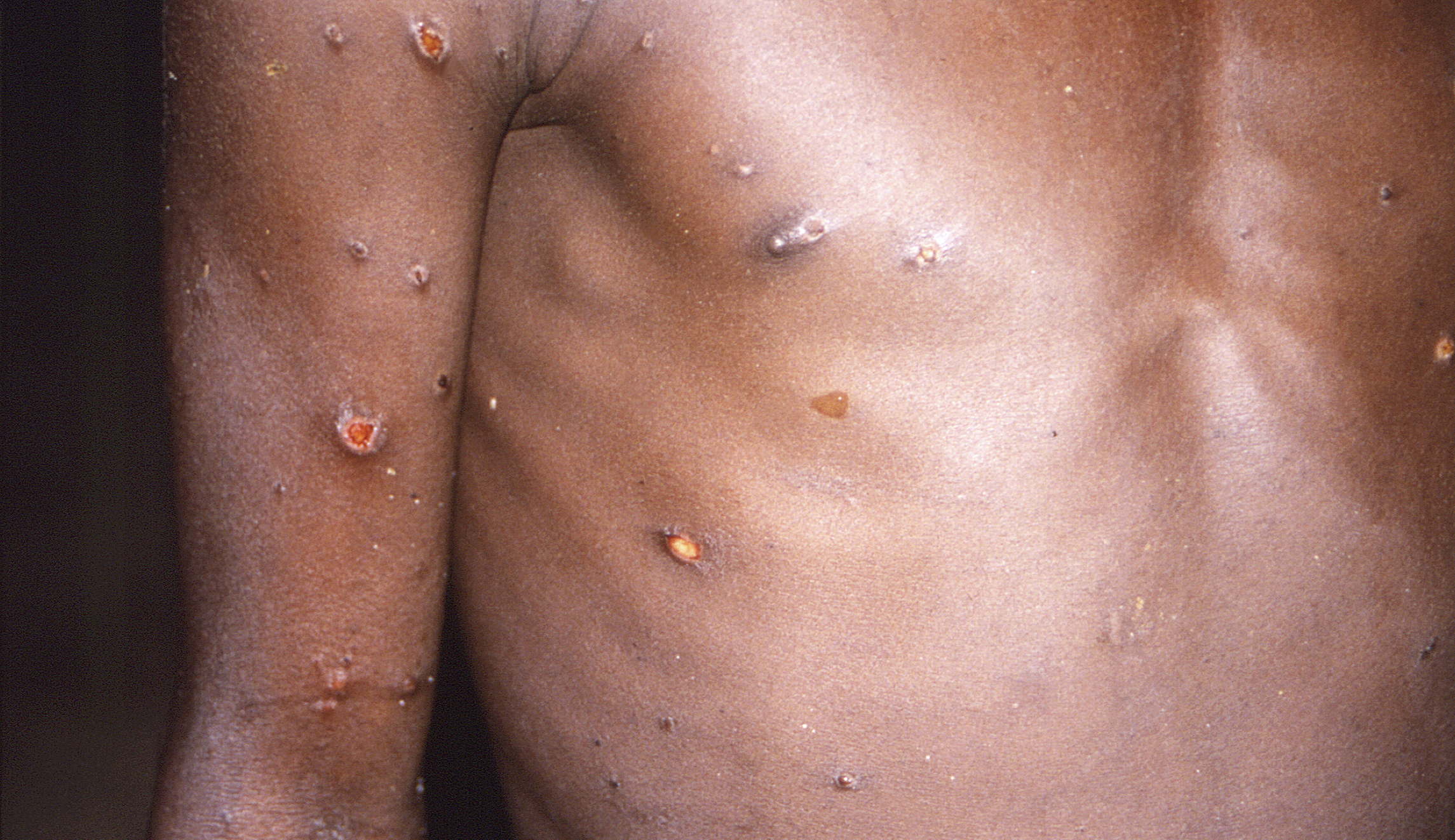 Lack of accessible monkeypox testing threatens response to outbreaks