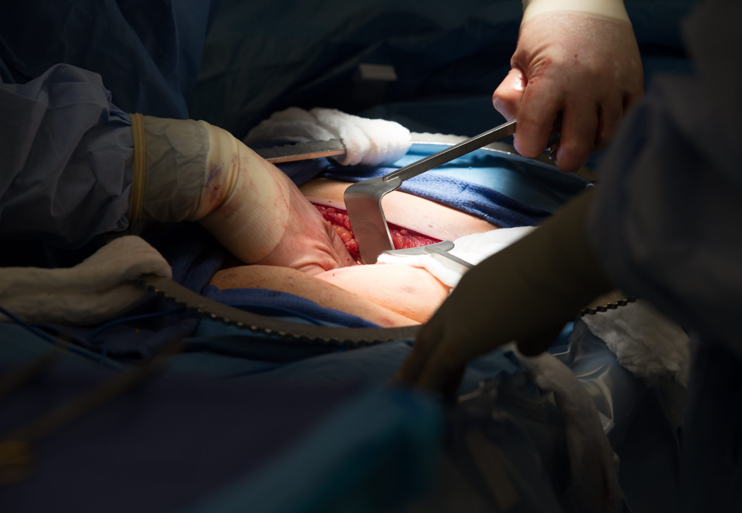 Company behind kidney transplant test sues competitor