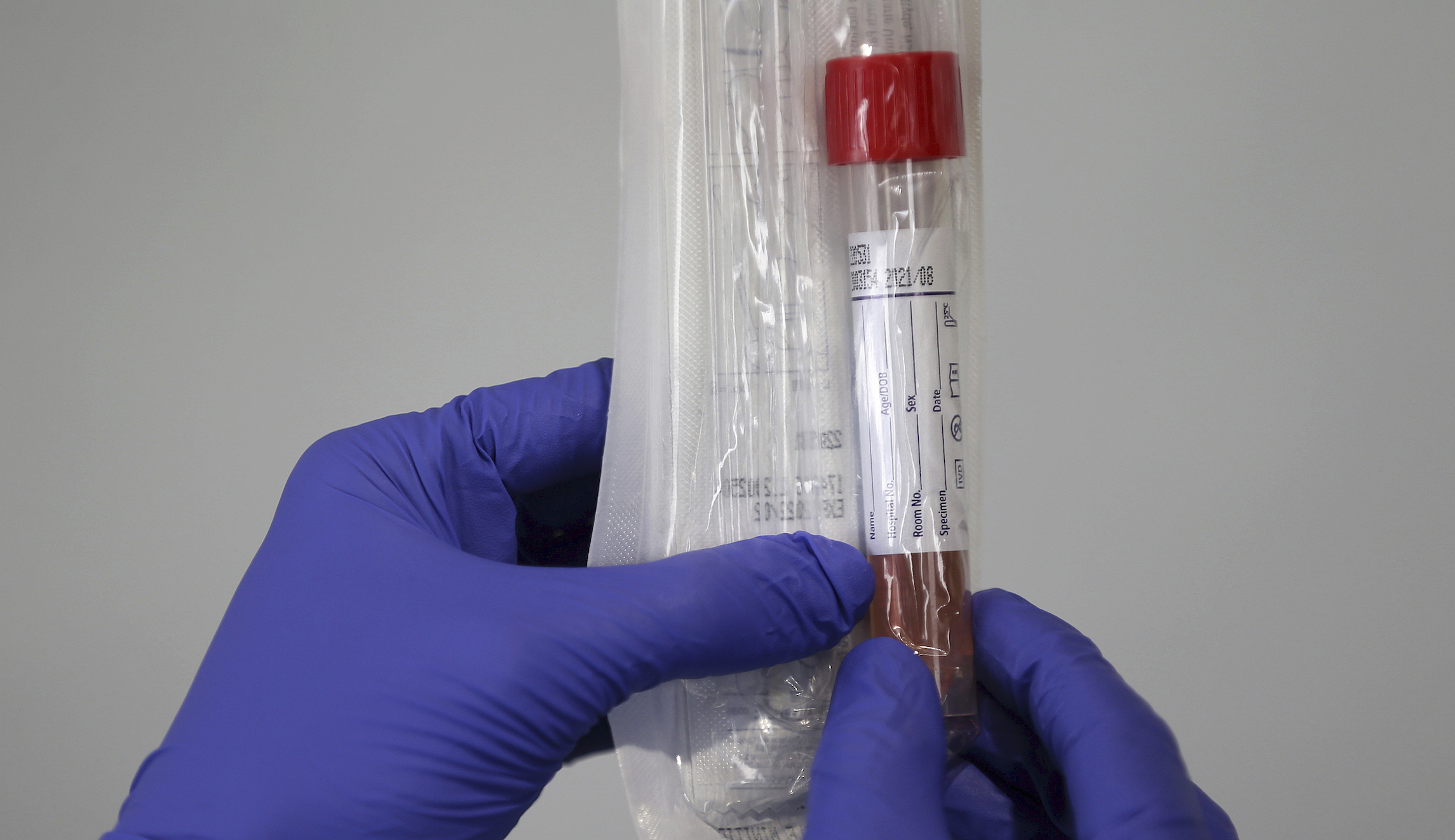 Coronavirus tests Spain purchased from China fail to detect positive cases