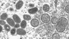 Los Angeles health officials report area’s first monkeypox death, second in US