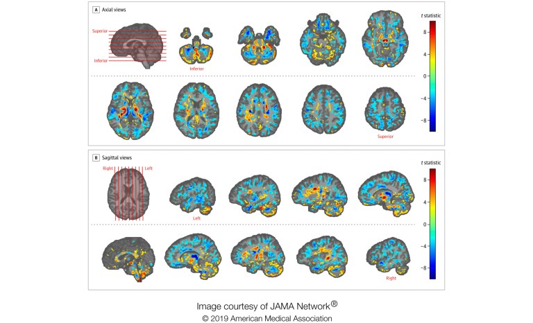 This image provided by the American Medical Association in July 2019 shows the amount of differences between brain scans of patients, U.S. diplomats who developed concussion-like symptoms after working in Cuba, and a control group. Between late 2016 and May 2018, several U.S. and Canadian diplomats in Havana complained of health problems from an unknown cause. One U.S. government count put the number of American personnel affected at 26. 