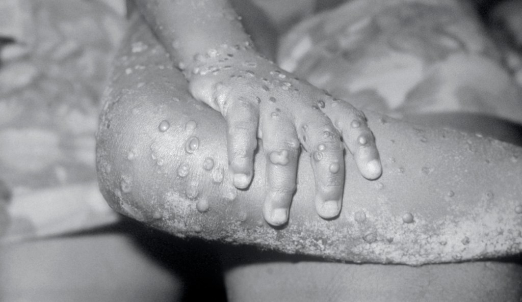 The absurdity of claiming ‘monkeypox’ is racist