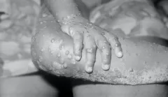 The absurdity of claiming ‘monkeypox’ is racist