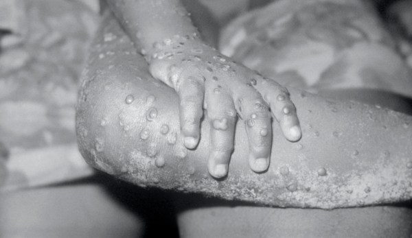 The absurdity of claiming ‘monkeypox’ is racist