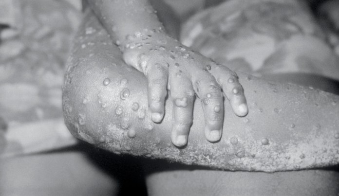 Monkeypox, a member of the orthopox family of viruses, is an infection accidentally transmitted to humans due to its similarity to the smallpox virus.