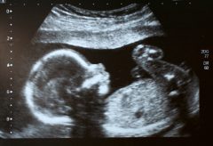 Another welcome blow against abortionists