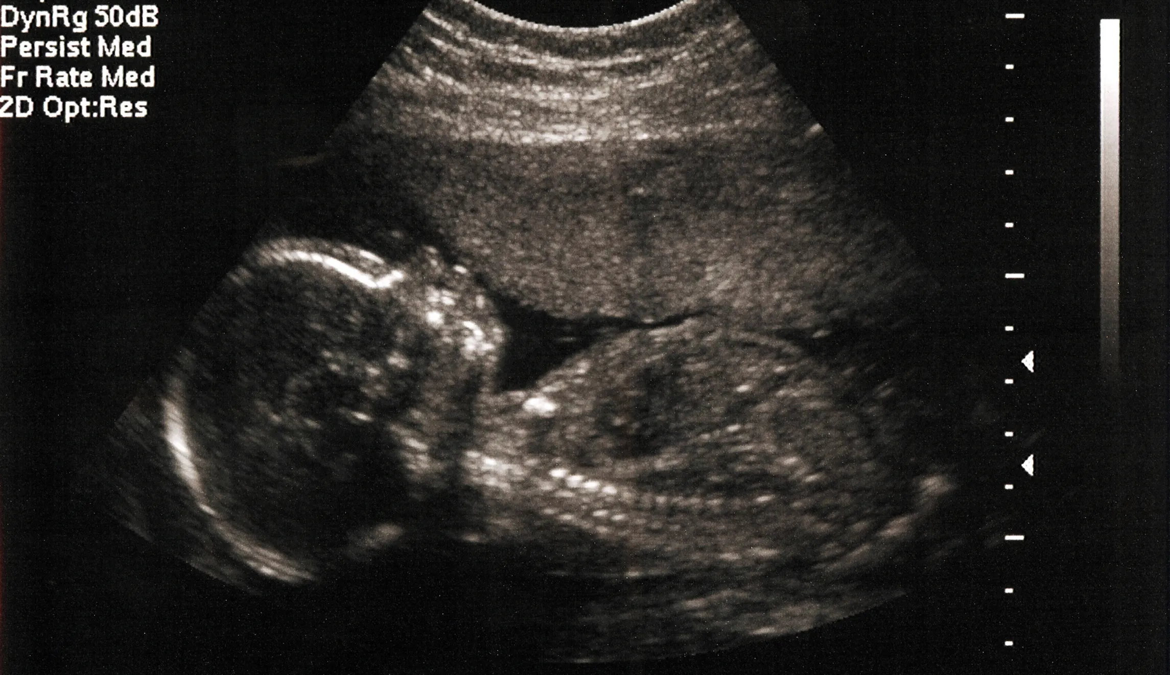 A court finally discusses whether abortion is humane