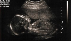 A court finally discusses whether abortion is humane