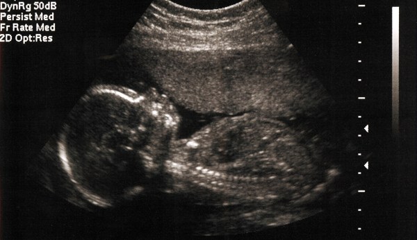 A court finally discusses whether abortion is humane