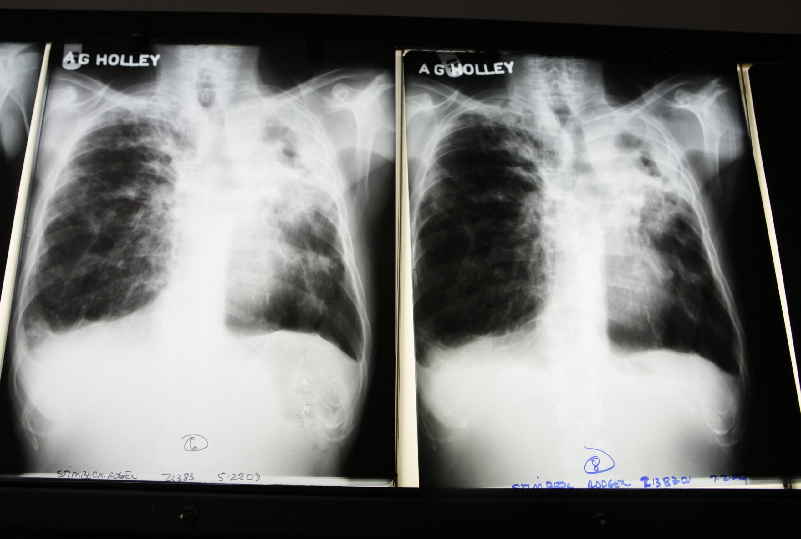 White House unveils plan to combat drug-resistant tuberculosis