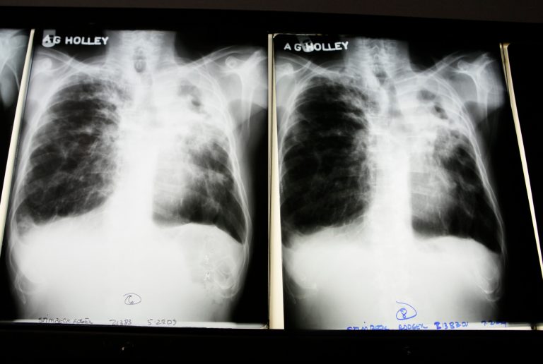 The White House released a plan to fight the spread of multidrug-resistant tuberculosis, a growing public health epidemic. (AP Photo/Lynne Sladky)