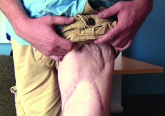 AP IMPACT: Surprising methods heal wounded troops