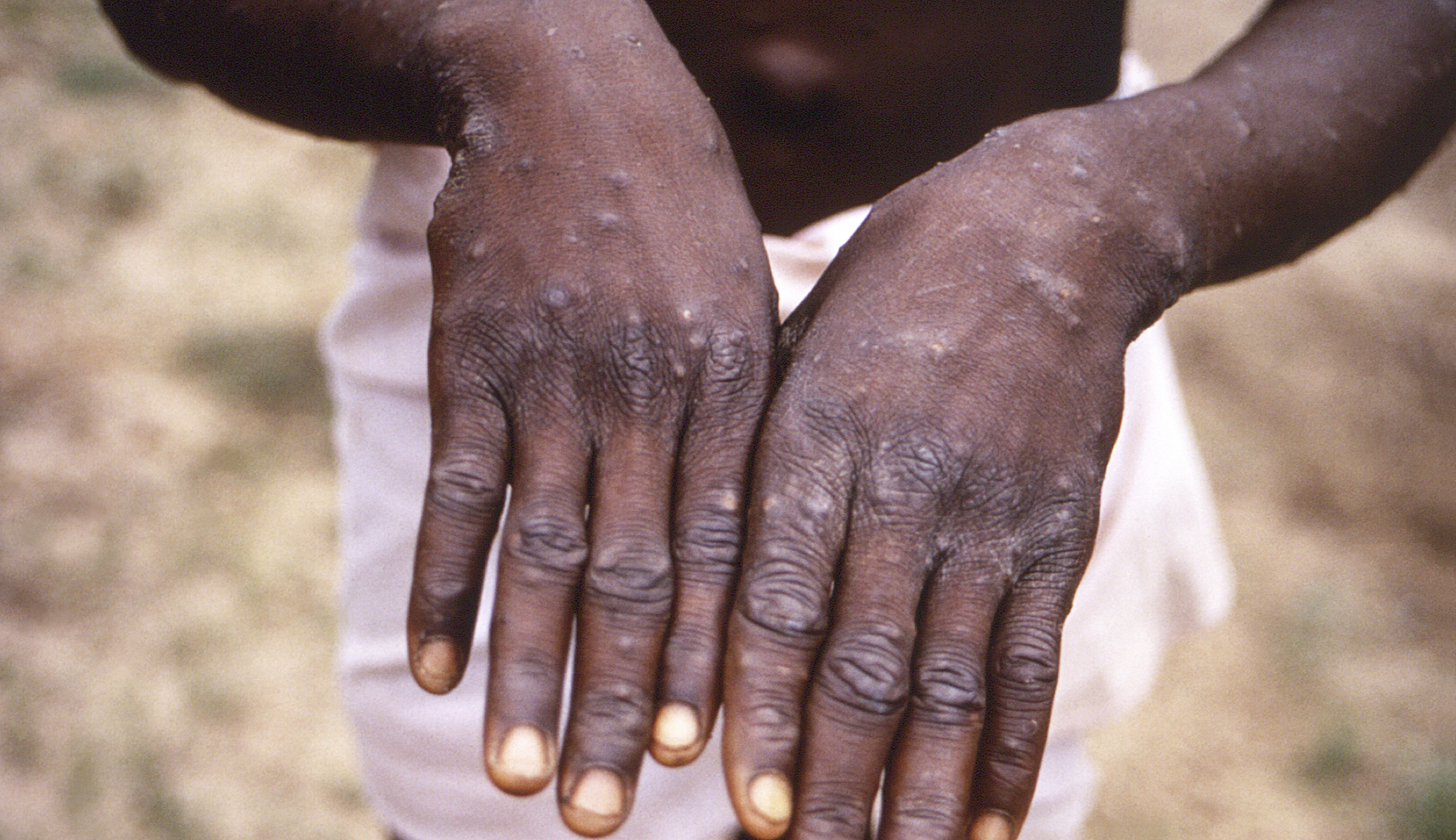 US monkeypox public health emergency imminent: Report