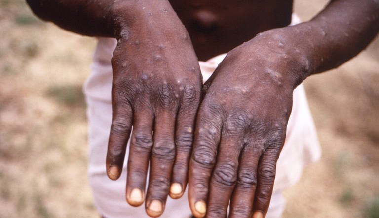 UK constructing COVID-esque tracker for monkeypox