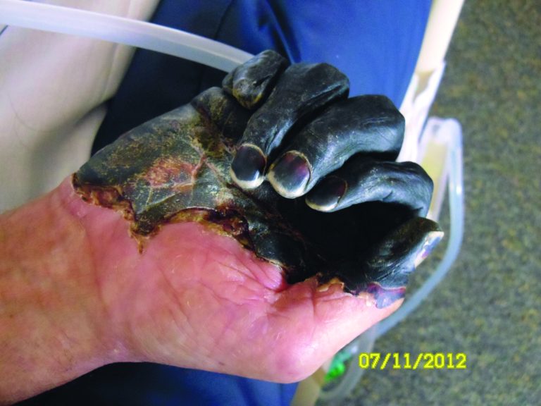 This photo supplied by the Gaylord family taken July 11, 2012, at a hospital in Bend, Ore., shows the blackened hand of Paul Gaylord as he recovers from the plague. Gaylord contracted the disease when he tried to pull a mouse out of the mouth of his cat, Charlie, because it was choking on the rodent. The disease, a version of the medieval scourge that wiped out at least a third of Europe, took away the 59-year-old welder's fingertips, his toes and his ability to make a living. He faces an arduous recovery surrounded by constant reminders of his misery, the infected cat died, and the trailer he's living in has a mouse problem. (AP Photo/The Gaylord Family, ho)