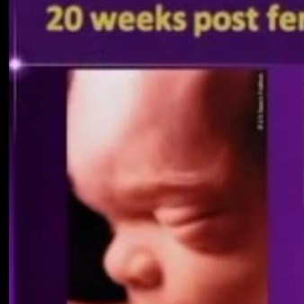 New York Times Falsely Reports Babies Born 20 Weeks After Conception Aren’t ‘Viable’