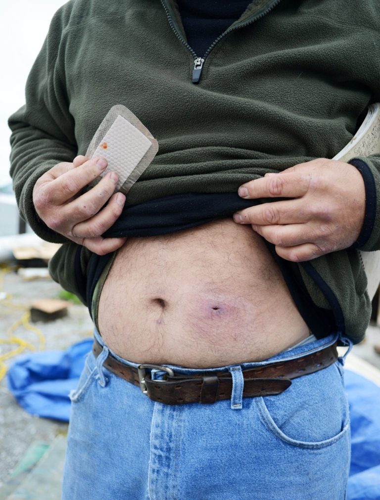 Bert Ducote shows the place where he had a boyle lanced and another boyle underneath his belly button that he claims are the result of being in direct contact with crude oil while performing cleanup work during the Deepwater Horizon oil spill. Photo taken at the Lake Catherine Marina in New Orleans, Friday, March 7, 2014. (AP Photo/Andrea Mabry)