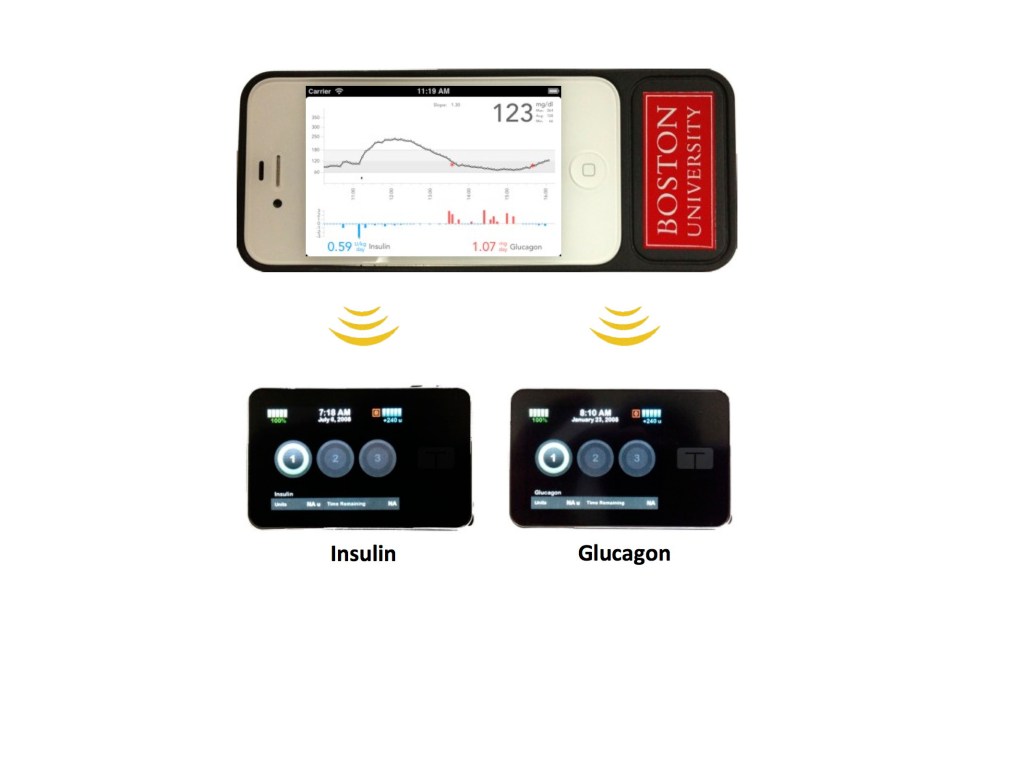 Progress made on a ‘bionic pancreas’ for diabetics