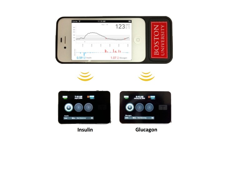 EMBARGOED FOR USE AFTER 9 PM EDT, SUNDAY, JUNE 15, 2014- This undated product image provided Boston University Department of Biomedical Engineering shows the bionic pancreas developed by a Boston University/Massachusetts General Hospital research team. The bionic pancreas consists of a smartphone, top, hardwired to a continuous glucose monitor and two pumps, bottom, that pumps deliver doses of insulin or glucagon every five minutes. (AP Photo/ Boston University Department of Biomedical Engineering)