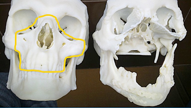This computerized tomography provided by the Cancer Center and Institute of Oncology in Gliwice, Poland, shows the skull of a 33-year-old Polish man after it was damaged in a work accident, right, alongside the healthy skull of another person. Polish doctors performed a total face transplant on the man on May 15 in a 27-hour operation. In a news conference on Wednesday they said it was the first time a life-saving face transplant was carried out soon after a recipient suffered damage. There have been several other transplants worldwide in recent years but in those cases doctors had months or years to prepare. The Polish patient suffered his accident on April 23, 2013.(AP Photo/Cancer Center and Institute of Oncology in Gliwice)