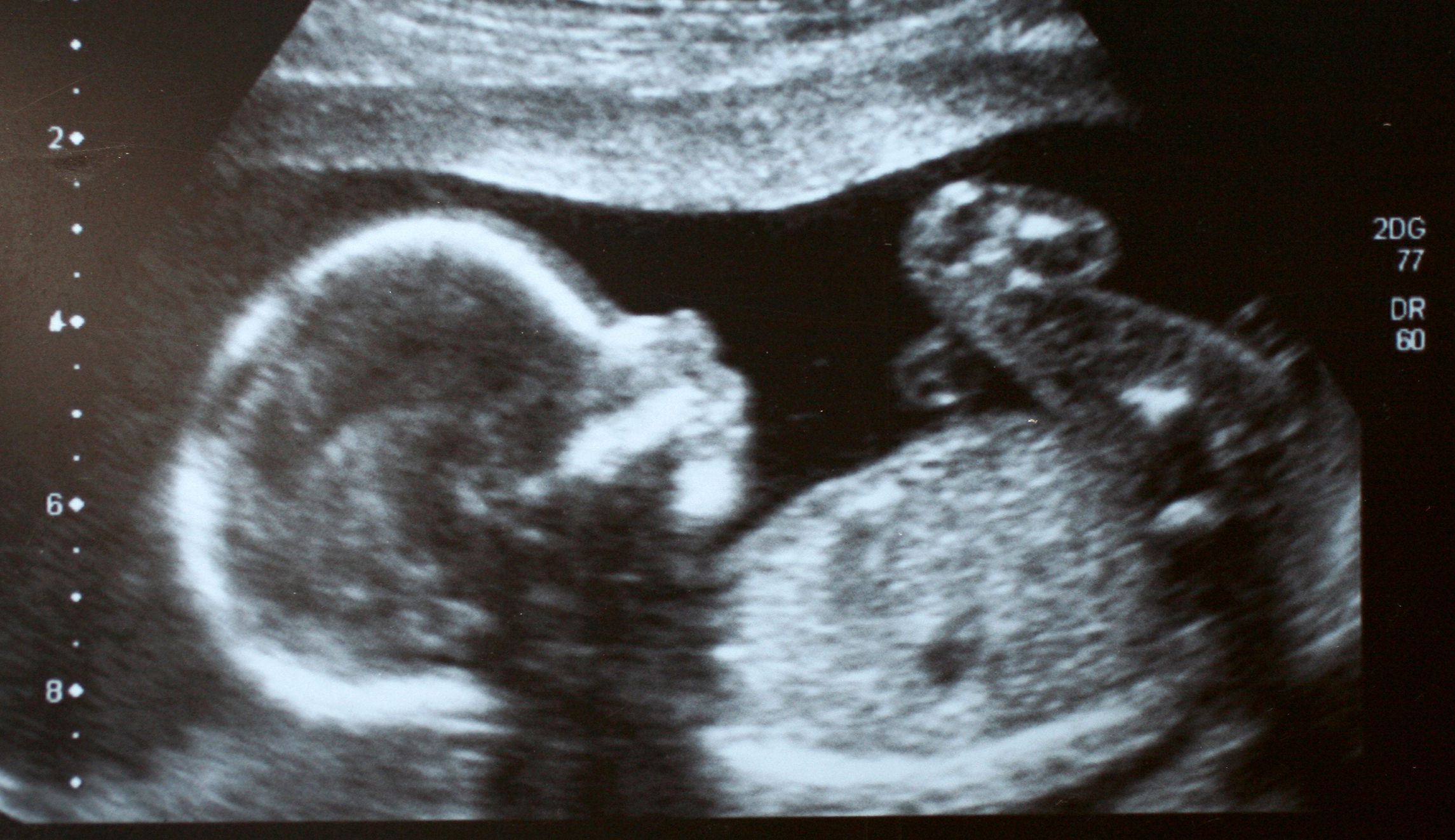 Democratic abortion arguments would fail high school biology