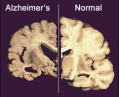 Families demand end to Medicare waiting period for early-onset Alzheimer’s patients