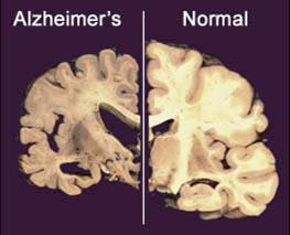   This undated image provided by Merck & Co., shows a cross section of a normal brain (right) and one of a brain damaged by advanced Alzheimer's disease. Alzheimer's patients and their families, desperate for an effective treatment for the epidemic disease, there's hope from new studies starting up and insights from recent ones that didn't quite pan out. (AP Photo/Merck & Co.)  