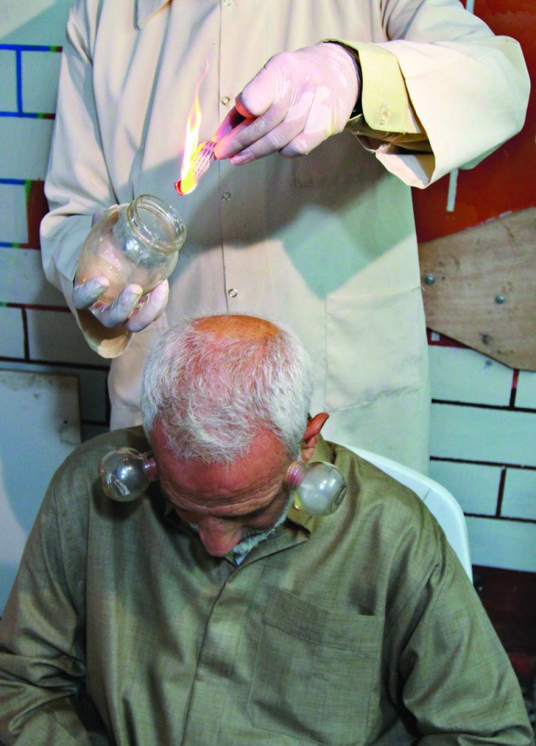 In this Monday, June 11, 2012 photo, Anwar Sheikh-Eid, 42, performs Hijama or cupping therapy, to Palestinian patient Musa Sheikh El Eid at his shop in the southern Gaza Strip city of Rafah. Cupping is an ancient form of alternative medicine whose advocates believe it improves blood flow and helps relieve a range of ailments from headaches to arthritis. (AP Photo/Adel Hana)