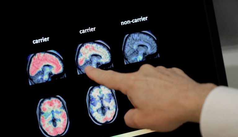 In cost-saving move, Medicare could limit patient access to Alzheimer’s treatment