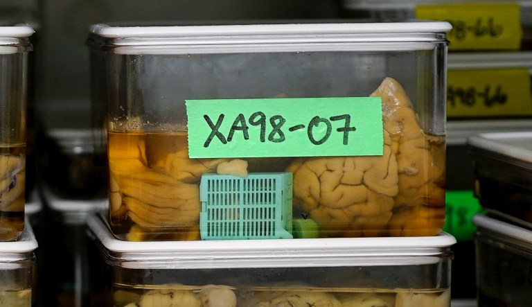 There’s a new Alzheimer’s wonder drug but don’t make Americans subsidize it for the whole world
