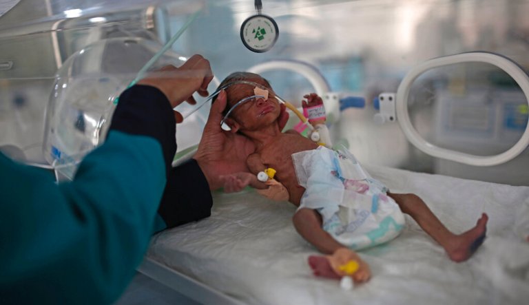 A medic checks a malnourished newborn baby inside an incubator at Al-Sabeen hospital in Sanaa, Yemen, Saturday, June 27, 2020.
