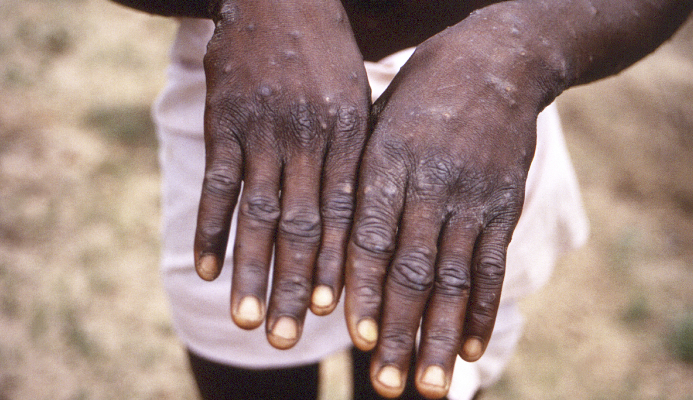 Officials outline latest steps to fight monkeypox outbreak