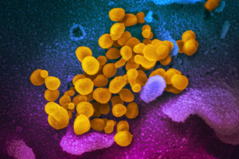 This undated, colorized electron microscope image made available by the U.S. National Institutes of Health in February 2020 shows the Novel Coronavirus SARS-CoV-2, indicated in yellow, emerging from the surface of cells, indicated in blue/pink, cultured in a laboratory. The sample was isolated from a patient in the U.S. Thereâs less risk of getting long COVID in the omicron era than in the pandemicâs earlier waves, according to a study of nearly 10,000 Americans that aims to help scientists better understand the mysterious condition, published in JAMA on Thursday, May 25, 2023. 