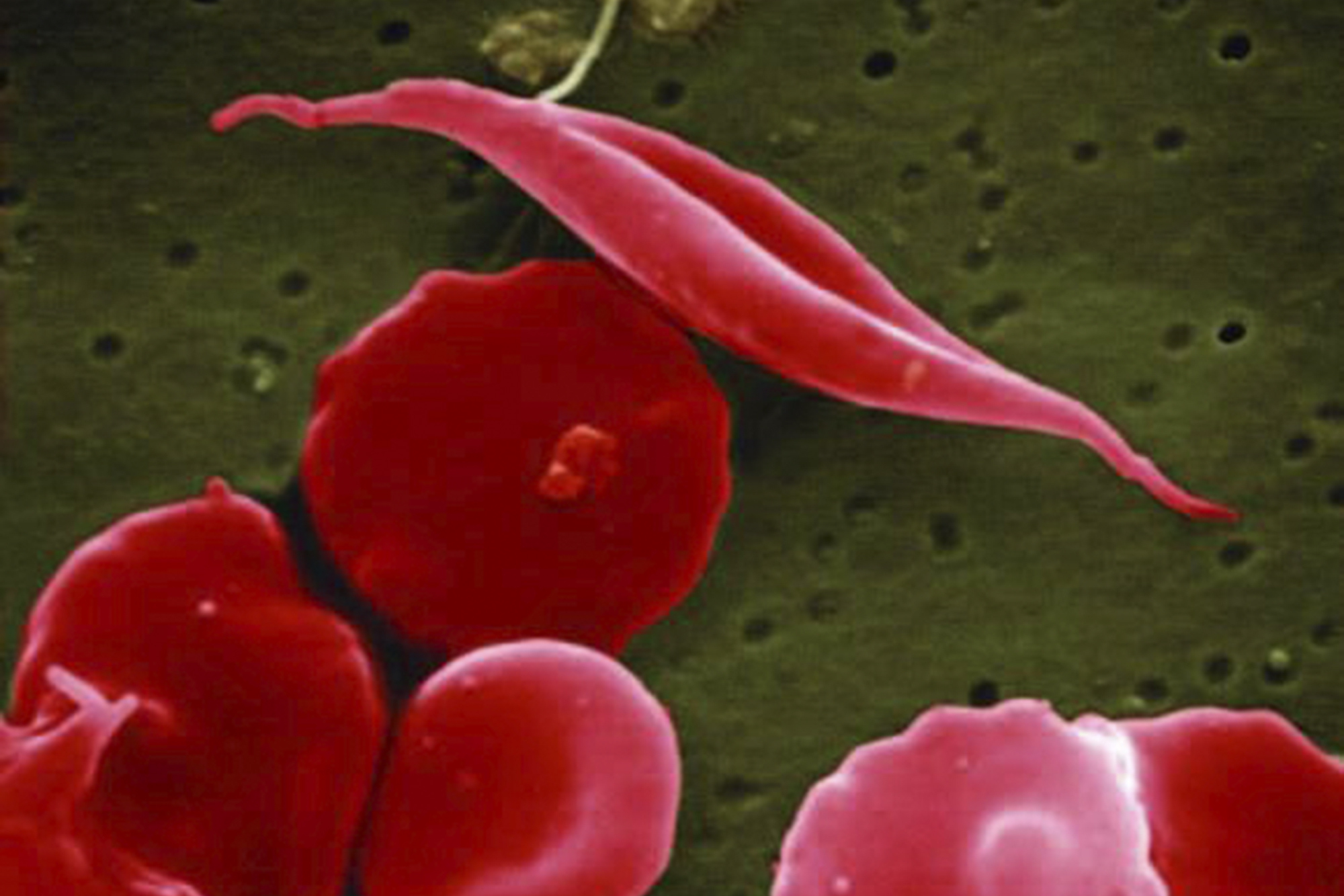 FDA approves world’s first CRISPR gene-editing drug for sickle cell disease