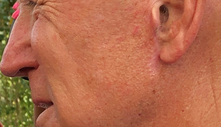 Joe Biden's scar.