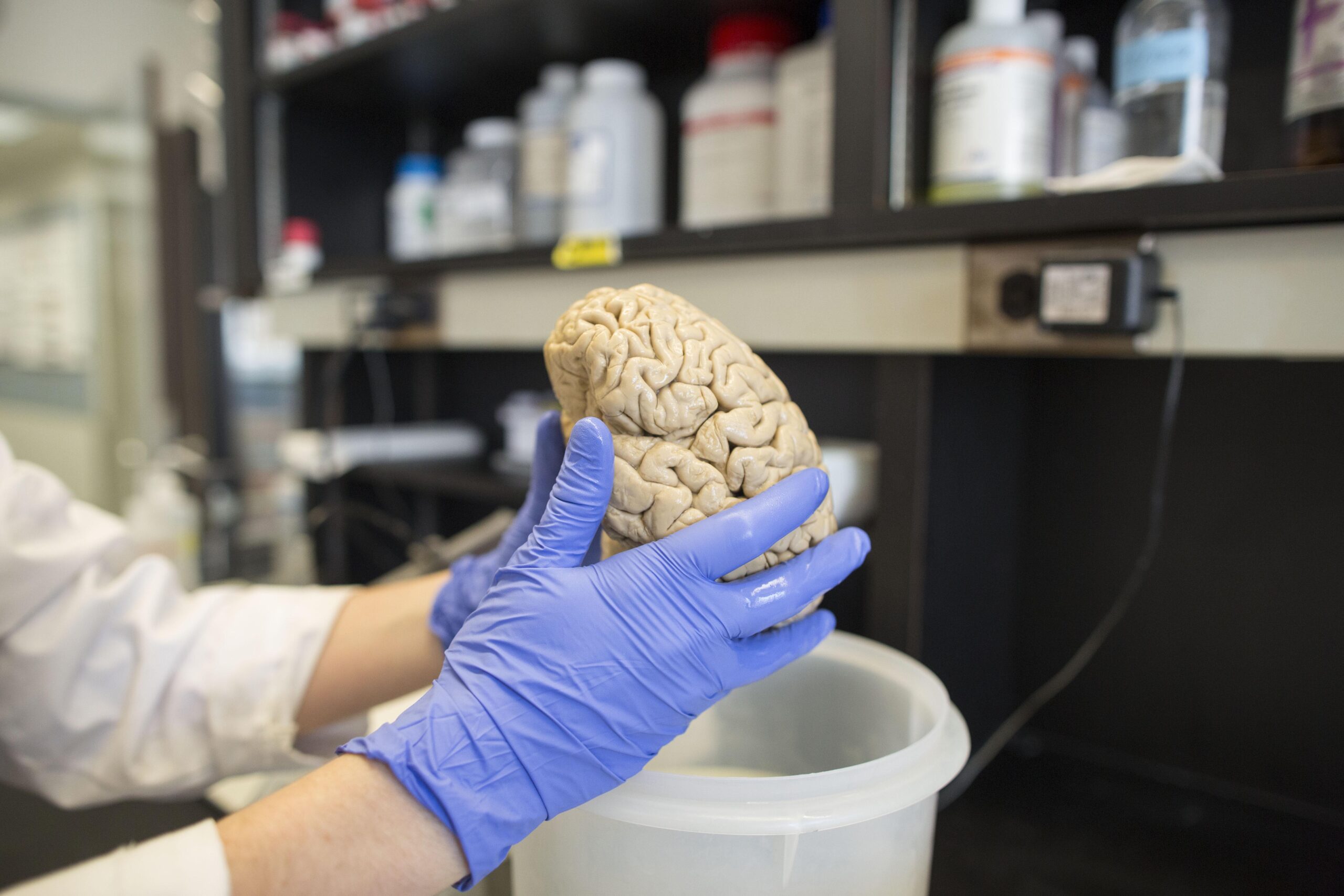 Medicare spending on Alzheimer’s to explode as boomers age: Analysis