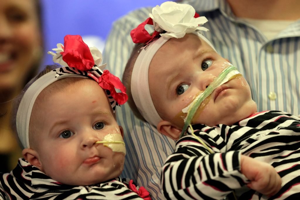 Once-conjoined NY twins make debut at Pa. hospital