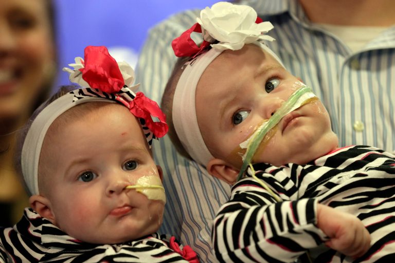   Shellie and Greg Tucker, parents of Allison, left and Amelia, present their nine-month-old girls who were formerly conjoined twins at Children's Hospital of Philadelphia (CHOP) Thursday, Dec. 20, 2012, in Philadelphia. Surgeons at CHOP separated the Tucker girls during a seven-hour operation in November. The infants from Adams, N.Y., had been joined at the lower chest and abdomen. They shared their chest wall, diaphragm, pericardium and liver. (AP Photo/Matt Rourke)  