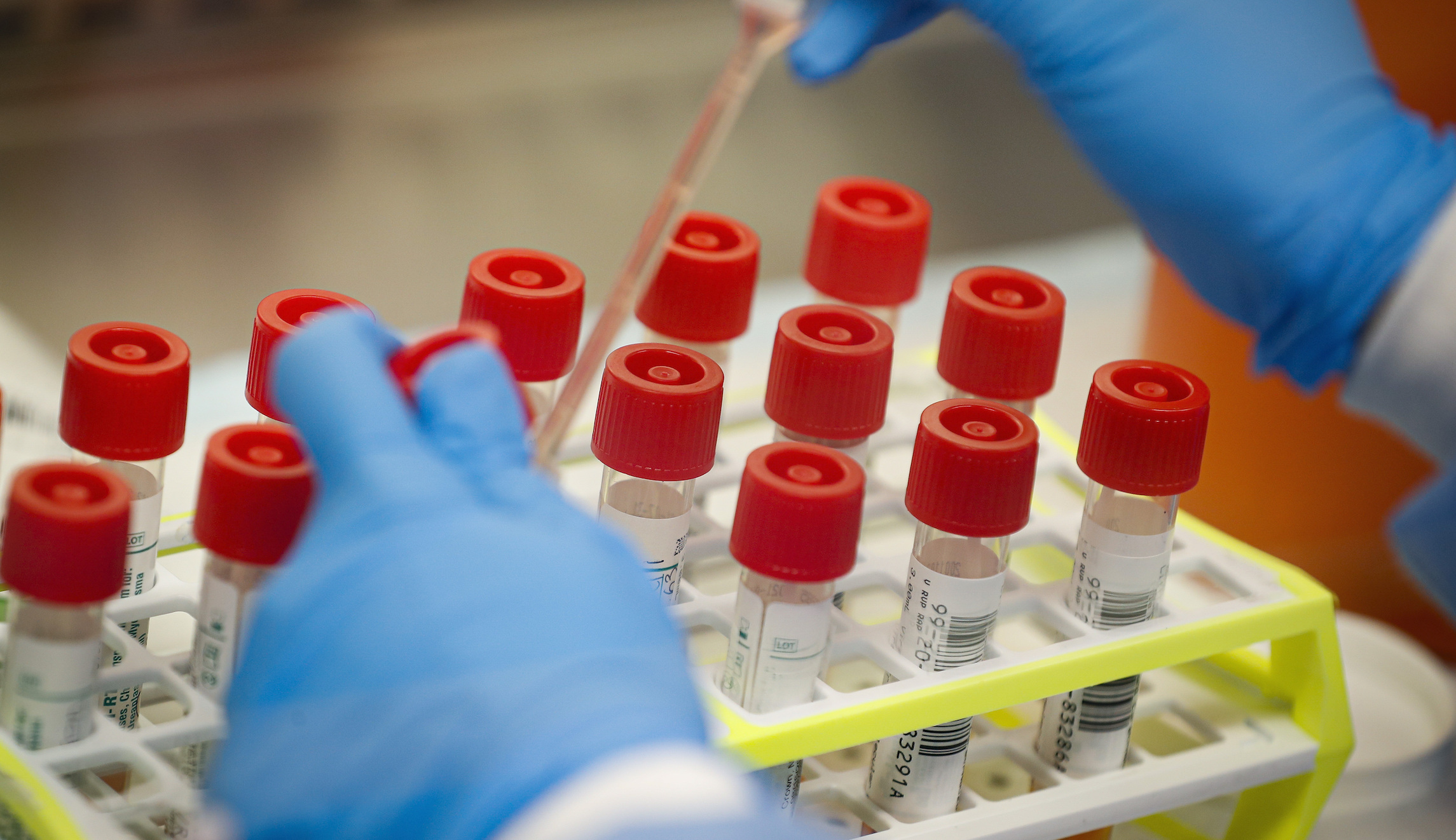 FDA approves coronavirus test that gives results in less than an hour