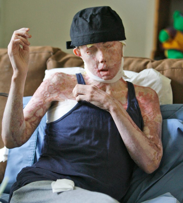   FILE - In this Aug. 20, 2008, file photo, Carmen Tarleton is interviewed in her home in Thetford , Vt. The Vermont woman who was disfigured and blinded in a lye attack by her ex-husband has written a book recounting her experiences. (AP Photo/Toby Talbot)  