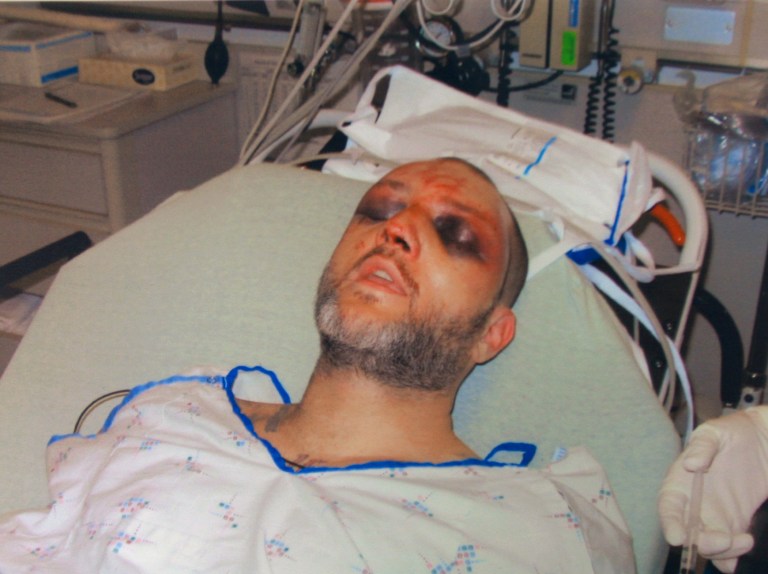 FILE - This file photo provided by the Washington County Hospital shows the bruising on Kenneth Davis' face that he alleges were inflicted by correctional officers at the Roxbury Correctional Institution near Hagerstown, Md., on March 8 and 9, 2008.  Josh Hummer, a former state correctional officer, is the first among 15 indicted officers to go to trial on federal charges stemming from Davis' beating. Jury selection for Hummer's trial begins Thursday, Jan. 23, 2014 in Baltimore. Twelve have pleaded out, but Hummer denies allegations that he failed to stop the assault, ignored the inmate's serious injuries and obstructed the investigation. (AP Photo/Washington County Hospital, File)