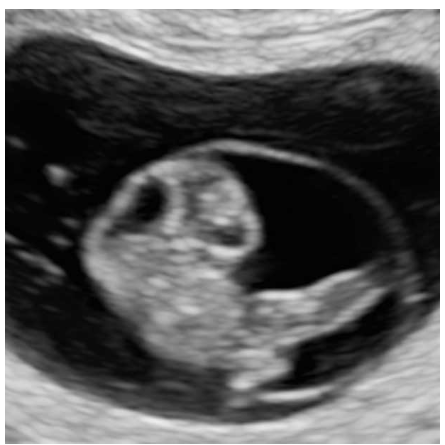 live embryo three weeks after missed period.png