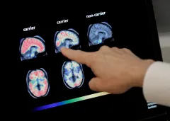 Early blood testing may predict dementia, research finds