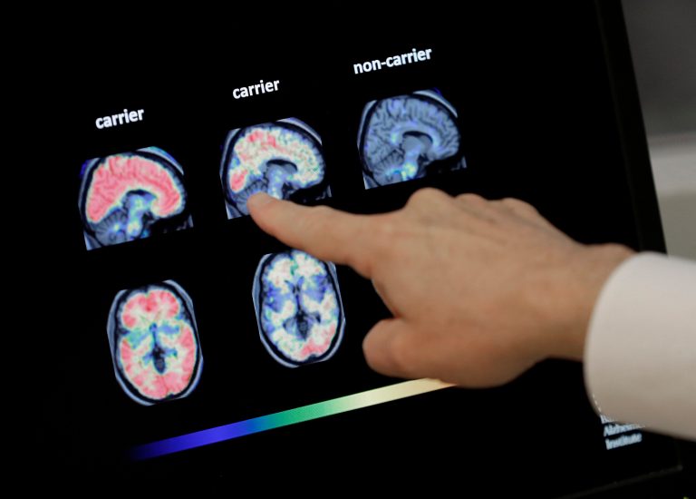 Early blood testing may predict dementia, research finds